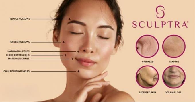 Regen Look Plla inyección de ácido poli-L-ácido hialurónico relleno para antienvejecimiento rejuvenecer la piel estimulación del colágeno 6